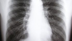 Industrial Disease - Occupational Lung Disease